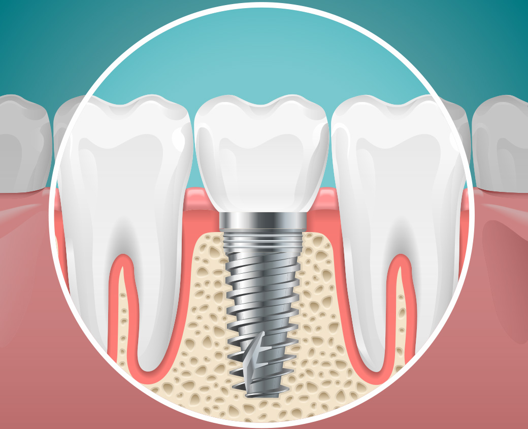 dental-implant-by-elonix