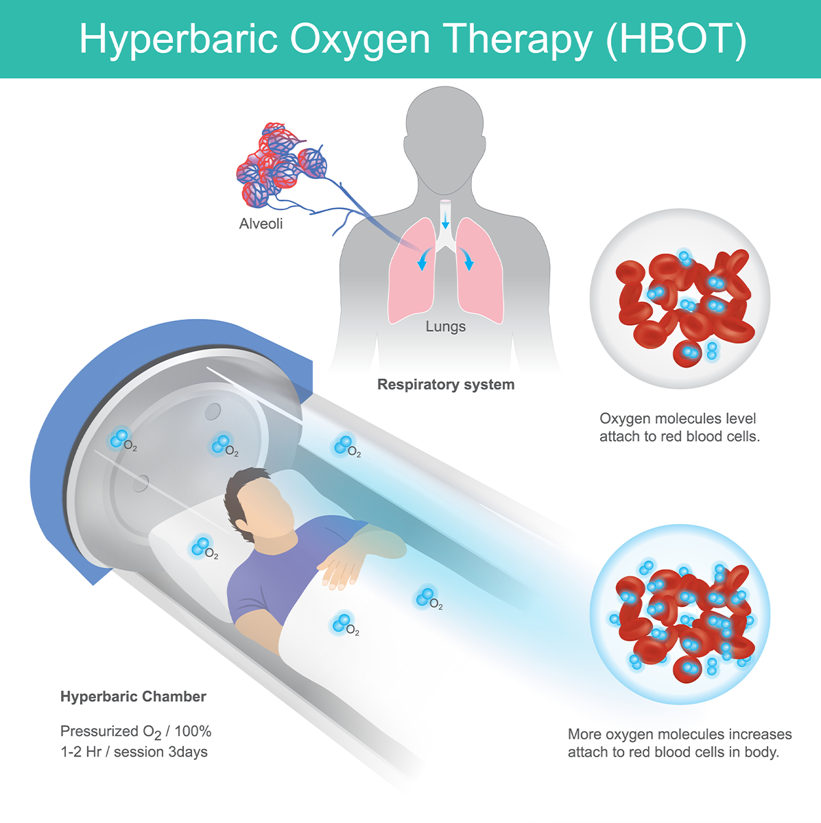 Hyperbaric Oxygen Therapy (HBOT) Hyperbaric Oxygen Therapy (HBOT)